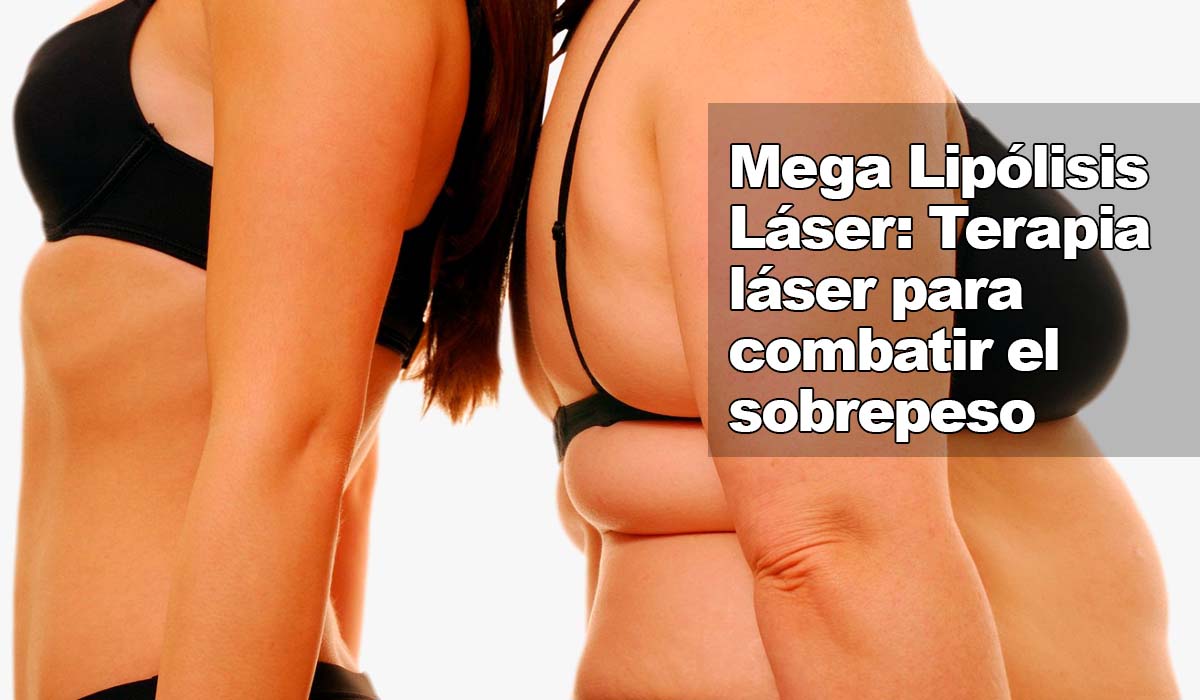 Descubre el método láser para eliminar sobrepeso: Lipólisis Láser