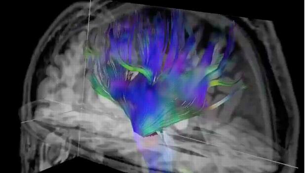 Resonancia magnética del cerebro.