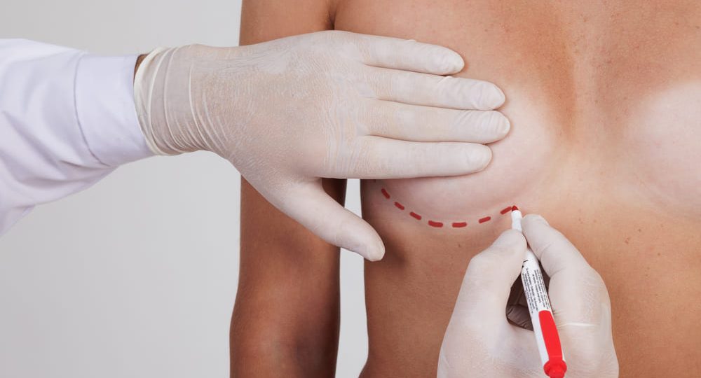 Reafirmación de senos después del embarazo sin cicatrices